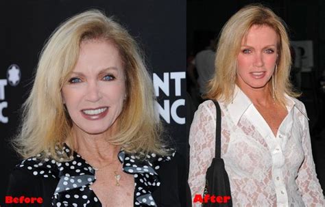 Donna Mills Plastic Surgery - With Before And After Photos