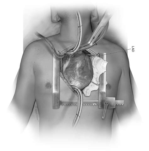 Implantation of two HeartMate 3s in the setting of a Total Artificial ...