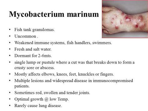 Other Mycobacteria - Bacterial Infections - AntiinfectiveMeds.com