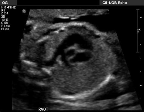 Left ventricular outflow tract view (fetal echocardiogram) | Radiology Reference Article ...