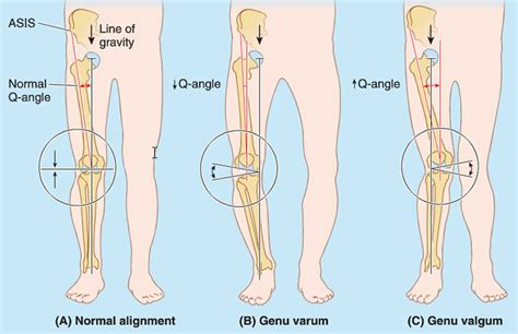 Patellar dislocation causes, symptoms, diagnosis, treatment & prognosis