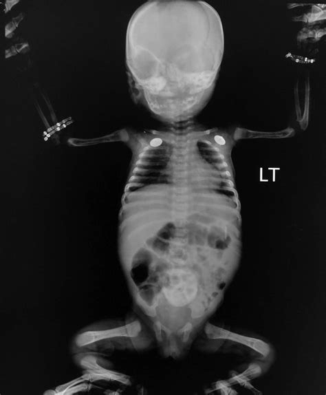 Severe microcephaly, intellectual disability and epilepsy: the ravages of congenital syphilis ...