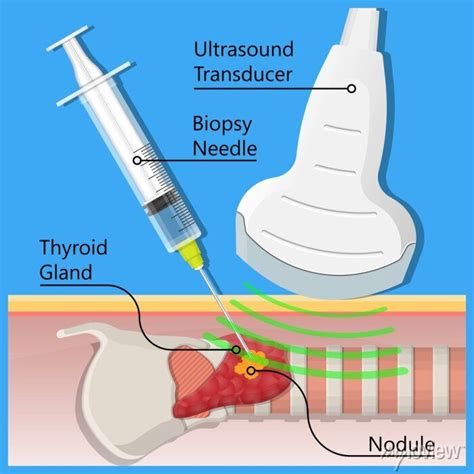 dilemma ictus pakistano fine needle aspiration procedure capitalismo Degno di nota Fatidico