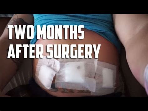 Two Months After Hernia Surgery - Recovery Update - YouTube