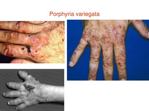 PPT - The classification of porphyria PowerPoint Presentation, free download - ID:566944