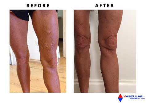 Laser Vein Treatment Perth | Varicose Veins, Perth, WA