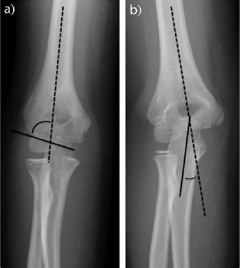 a) Baumann's angle; b) ulnohumeral angle. | Download Scientific Diagram