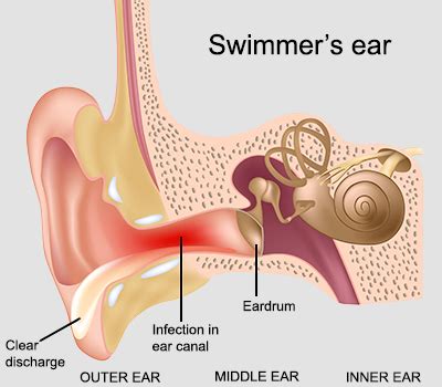 Swimmer's ear (otitis externa) – symptoms and treatment | healthdirect