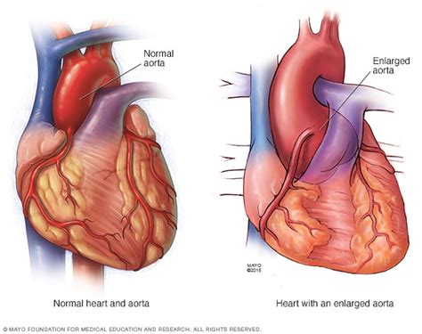 Marfan syndrome - Symptoms and causes - Mayo Clinic