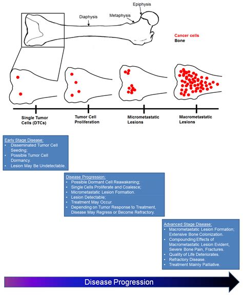 Cancers | Free Full-Text | Cancer Metastases to Bone: Concepts, Mechanisms, and Interactions ...