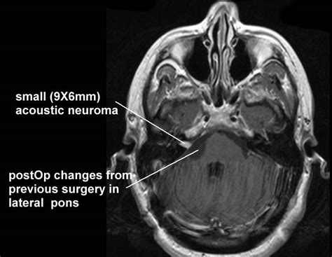 Acoustic Neuroma MRI Images