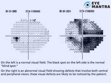 Visual field tests for Glaucoma: Uses, procedure& cost | Eyemantra