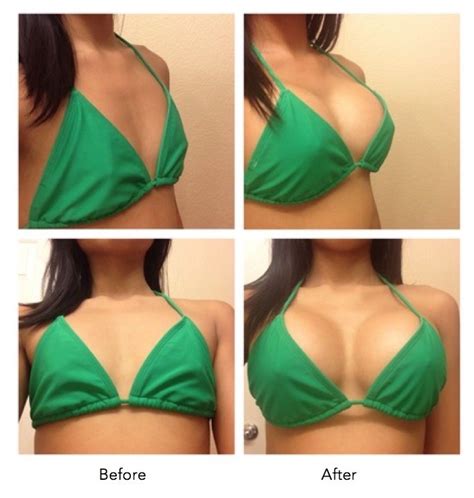 Understanding Breast Augmentation - WaysToIncreaseBreast.com