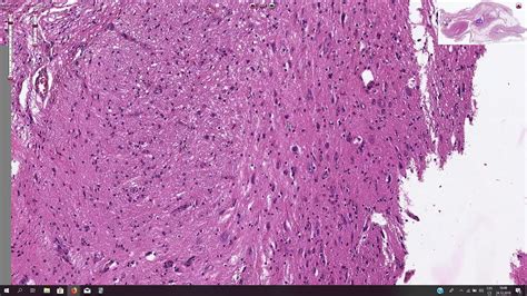 Mature Teratoma, Ovary - Histopathology - YouTube