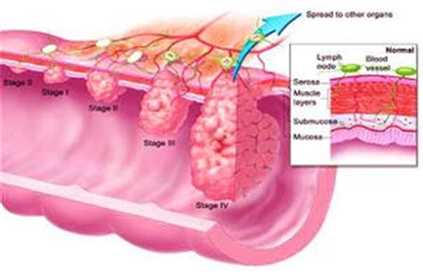 Diagram colon cancer | Anatomy System - Human Body Anatomy diagram and ...