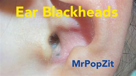 Ear Blackhead extractions.Deep in the ear blackheads.Quick extractions, one dry, one juicy ...