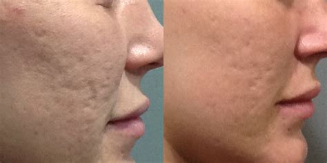 Microneedling Before and After Gallery - Dermatologist Choice