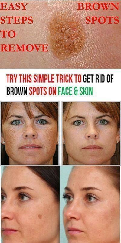 How to Get Rid of Brown Spots on Face and Hands | Brown spots on face, Brown spots on skin ...