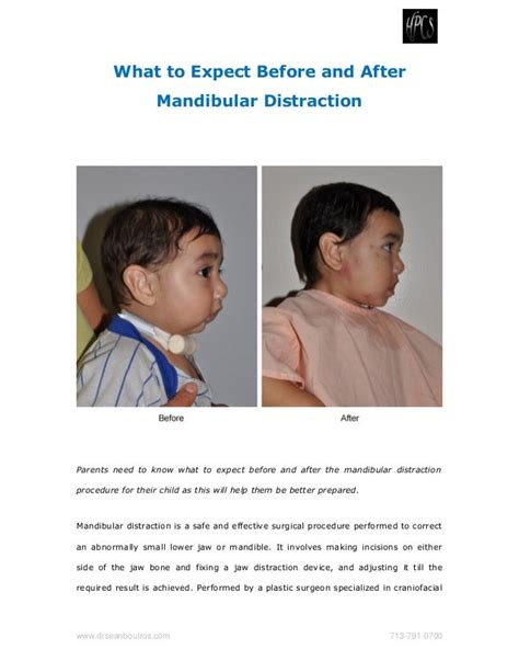 What to Expect Before and After Mandibular Distraction