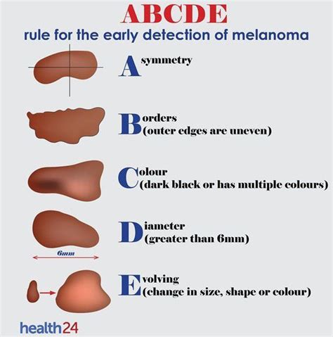 ABCDE Rule for Melanoma - MEDizzy