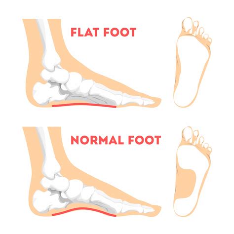 Ankle Sprains Situations With Inversion And Eversion Injury Outline Diagram Stock Illustration ...