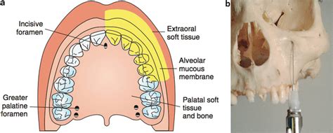 Anterior Superior Alveolar Nerve Block