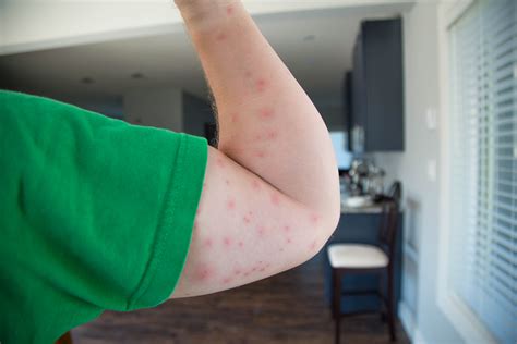Bed Bug Bites: What Are They? - Phoenix Pest Control And Exterminators