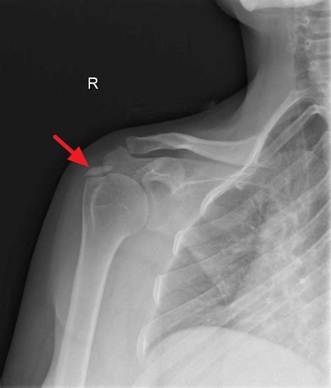 Rotator Cuff Calcific Tendinosis