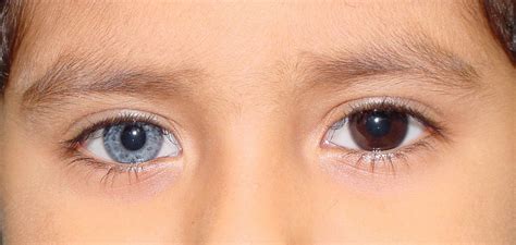 Heterochromia Awareness: Do You Know? LexLeader