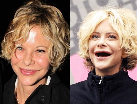 Meg Ryan Before and After Plastic Surgery: Face, Nose, Lips