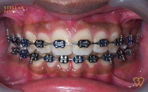 Braces Colors: Top Picks For 2023 - Stellar Dental