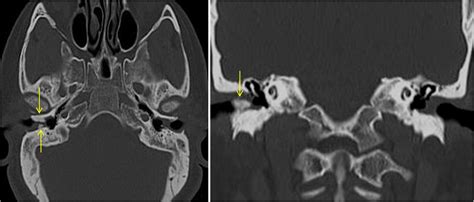 Exostosis of the external auditory canal - Surfer's ear | Image ...