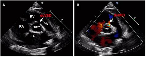 Frontiers | Transfemoral Occlusion of Doubly Committed Subarterial ...