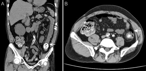 Fecalith Formation and Colonic Perforation After Lanthanum Carbonate Granules Administration ...