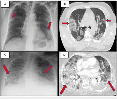 (A) CXR of case 1 showing bilateral patchy infiltrates. (B) CT chest of... | Download Scientific ...