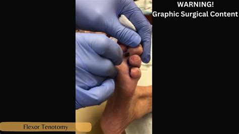 Flexor Tenotomy (Hammertoe, Mallet toe correction) - YouTube