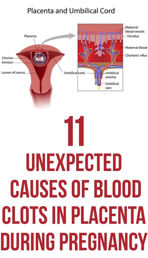 11 Causes Of Blood Clots In Placenta During Pregnancy