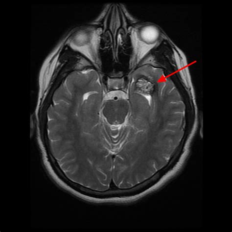 Cavernous Malformation - Cause, Brain Stem Symptoms, Treatment