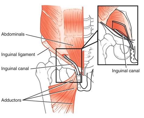 Sports hernia - Symptoms & Treatment | BioHernia