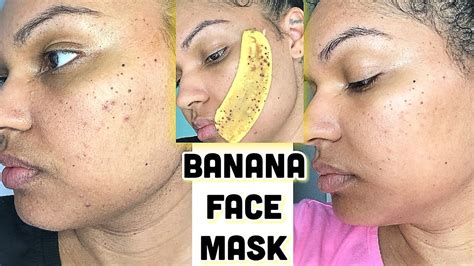 I Rubbed Banana Peel On My Face & My Pimples & Acne Scars Are Gone |5 Day Banana Face Mask ...