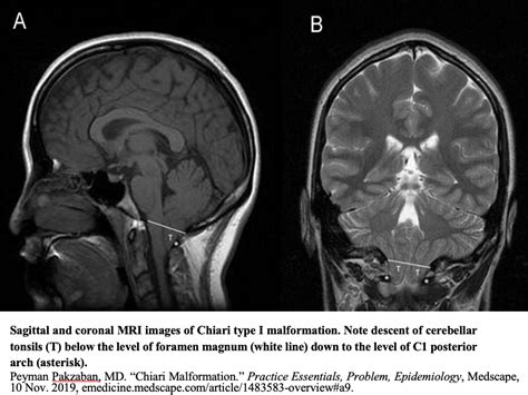 Chiari Type I Malformation - Pediatrics - Neurosurgery - Neuropedia