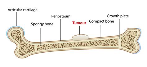 Bone cancer | healthdirect