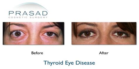 Thyroid Eye Disease- Graves Disease | Prasad Cosmetic Surgery | NY