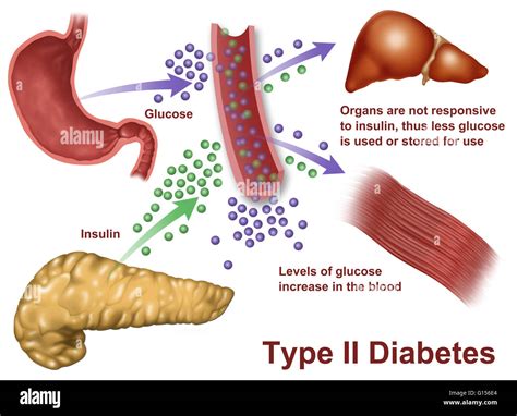 llustration of insulin and glucose production in Type 2 diabetes Stock ...