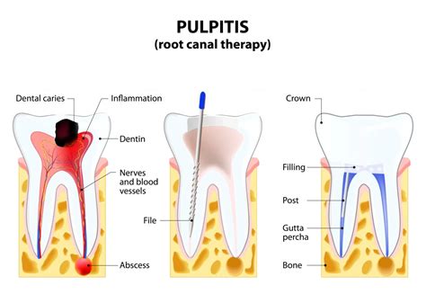 Root Canal Treatment In Orlando, FL By Hunters Creek Dental