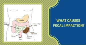 Causes of Faecal Impaction - Dr Maran - Springfield Wellness Centre | Bariatric and Metabolic ...