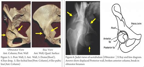 Understanding Clinical Radiology of Fracture Acetabulum – Trauma International