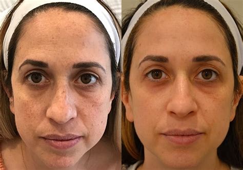 BBL Photofacial | Broadband Light Facial Procedure | New Jersey