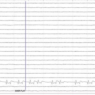 Brainstem auditory evoked response (BAER). For all figures: Top tracing ...