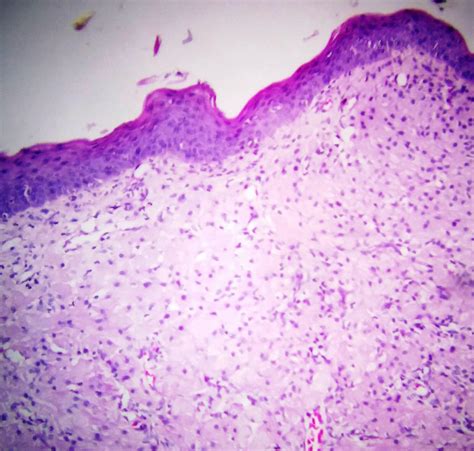 Congenital Epulis Histology